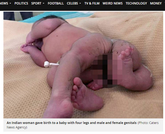 ▼▲印度龍鳳胎分化不完全的新生兒。（圖／翻攝自英國鏡報）
