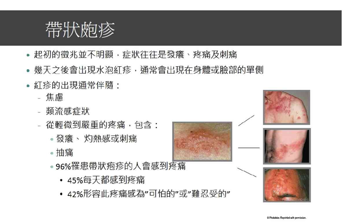 婦人疲累腰痛飽受折磨帶狀皰疹神經痛惹禍 Ettoday生活新聞 Ettoday新聞雲