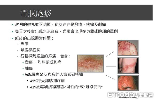 ▲帶狀皰疹俗稱「生蛇」或「皮蛇」，是因水痘病毒即使痊癒後，病毒躲到人體的神經節裡，當免疫力下降，病毒再度被活化，而侵犯神經節，引起神經發炎疼痛。（圖／記者林悅翻攝）