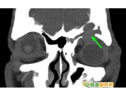 鼻竇炎作祟細菌入侵噬骨 Ettoday健康雲 Ettoday新聞雲