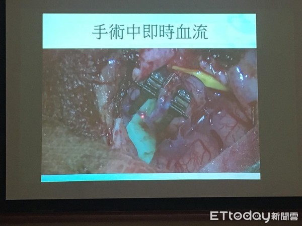 ▲毛毛樣血管病。（圖／記者嚴云岑攝）