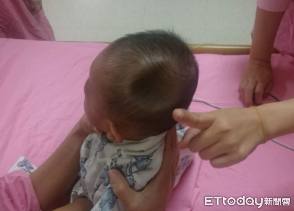 ▲4月大男嬰車禍撞儀表板　顱骨凹陷「像蘋果咬一口」。（圖／高雄長庚提供）
