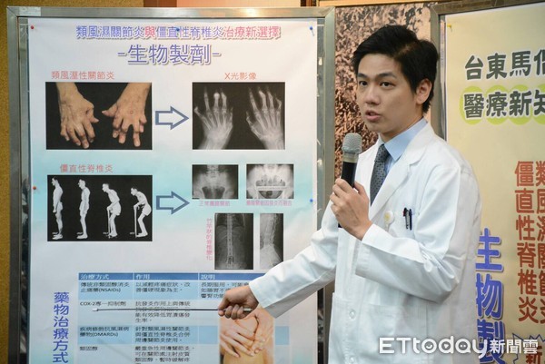 罹僵直性脊椎炎儘早就醫生物製劑助病人重新站起來 Ettoday生活新聞 Ettoday新聞雲