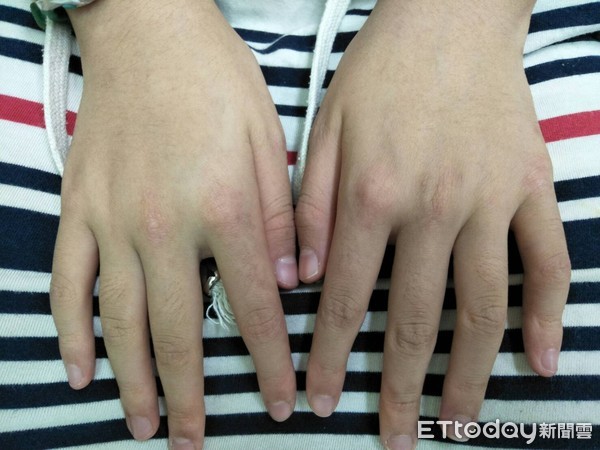 皮肌炎临床症状,会出现双手皮肤红疹.