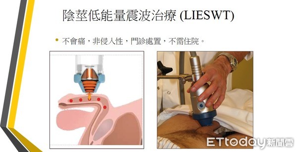 ▲低能量震波治療(LIESWT)原理，是利用特殊探頭產生低能量震波，作用於陰莖海綿體，藉以改善海綿體神經功能，同時促使血管內皮修復與血管新生。（圖／記者林悅翻攝）