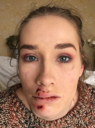 ▲▼英國20歲女子詹寧斯（Georgia Jennings）1日在伍爾弗漢普頓（Wolverhampton）遭到陌生男子攻擊。（圖／翻攝自臉書／Georgia Jennings）