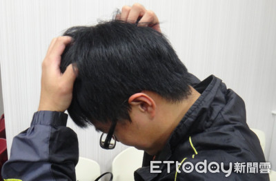 頭皮屑像撒麵粉！19歲男癢爆「血染枕頭」　醫嘆：媽媽潔癖害的