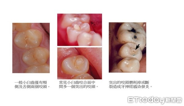 ▲牙齒先天構造而造成問題不在少數，常見在小臼齒的咬合面上多一個凸出來的「咬頭」，容易因為吃東西導致咬頭斷裂或磨耗而造成牙神經感染。（圖／記者林悅翻攝）