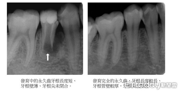 ▲永久齒若在牙齒生長發育的期間，牙神經感染而發炎壞死，牙齒就會停止生長，繼而出現牙痛、牙齦腫、蜂窩性組織炎等。（圖／記者林悅翻攝）