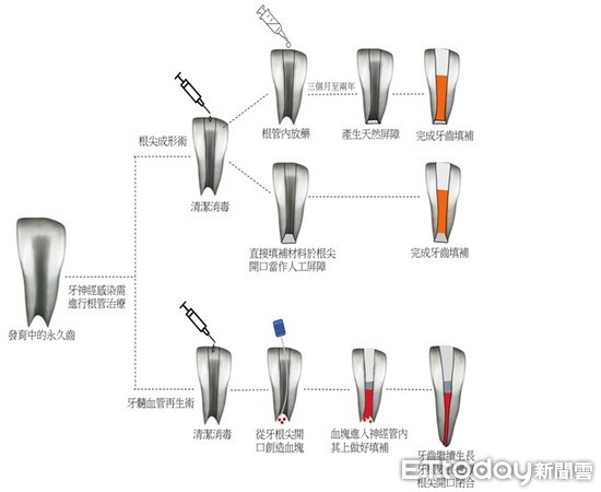 ▲牙神經血管再生術，讓受感染的發育中永久齒能繼續生長，以增加牙根的長度與厚度，增加牙齒抵抗斷裂的能力，增加牙齒的使用年限。（圖／記者林悅翻攝）