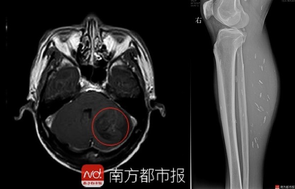 吃沒熟豬肉害他痛苦16年　衰男腦內與雙腿爬滿囊蟲！（圖／翻攝自大陸《南方都市報》）