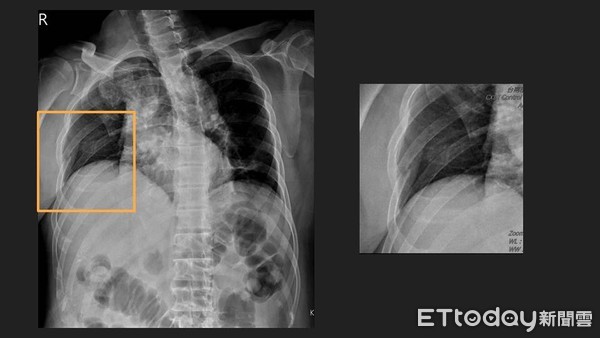 ▲患者經歷嚴重車禍造成肋骨骨折。（圖／安南醫院提供）