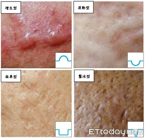 ▲青春痘經感染、發炎後，會進入一段組織修護期，進而形成疤痕組織，疤痕又可區分為增生型與萎縮型2種。（圖／成醫提供）