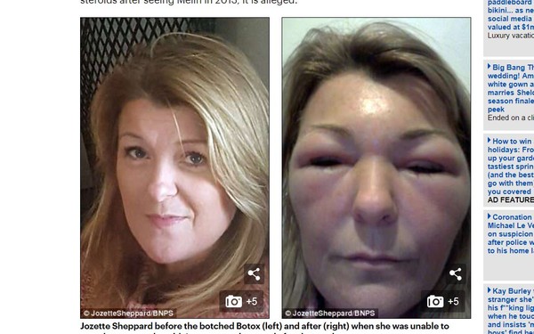 ▲▼冒牌醫謊稱注射肉毒桿菌　女客戶腫如倉鼠：感覺到滲血。（圖／翻攝自《每日郵報》）