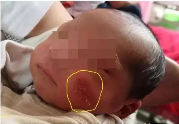 剖腹產手術刀割臉！　初生女嬰左臉慘縫8針。（圖／翻攝自大陸《遼沈晚報》）