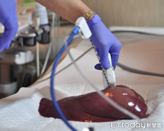 ▲肝腫瘤治療新技術　微波加熱「煮熟」癌細胞。（圖／台北榮總提供）