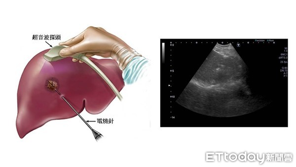 ▲台南市立安南醫院消化內科湯昇曄醫師指出，早期肝癌病人施以肝癌射頻燒灼效果佳。（圖／安南醫院提供，下同）