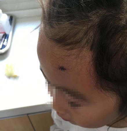▲▼女童在上海迪士尼撞八角形燈柱縫兩針             。（圖／翻攝自澎湃新聞）