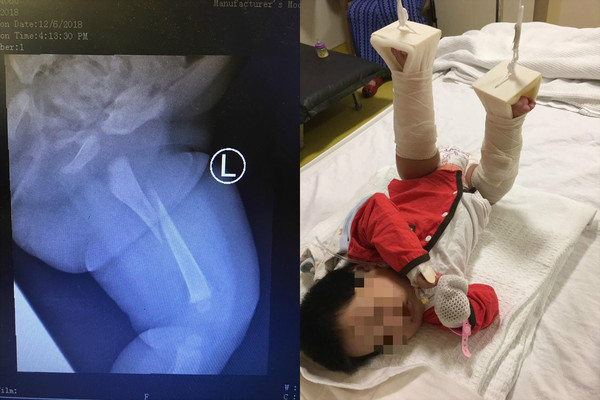 3個月女嬰腿骨斷裂「雙腿懸空吊起」　疑遭惡保母虐待。（圖／翻攝自Muhsin Zaidi的臉書）