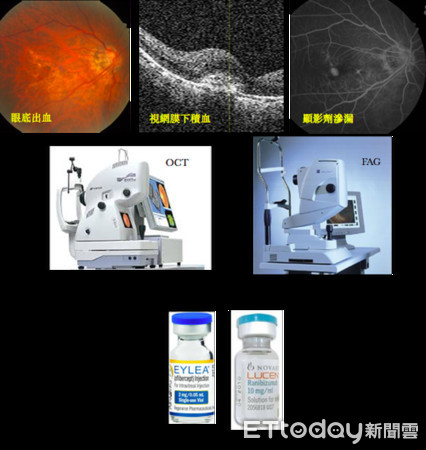 ▲眼科薛維禎醫師指出，少數的黃斑部退化，是所謂的濕性黃斑部病變，會明顯影響視力或是視覺感受，須接受積極治療。（圖／安南醫院提供，同下）