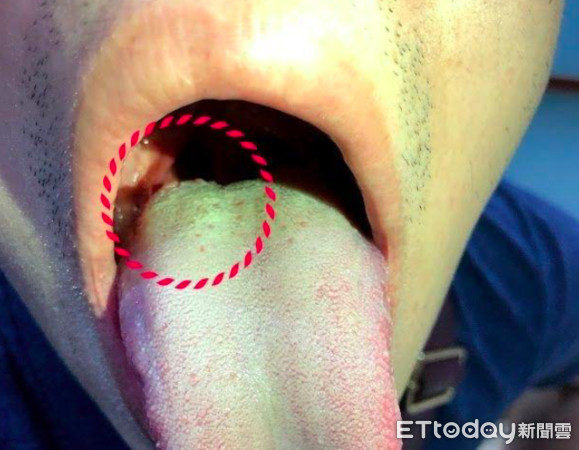 感染hpv的舌头图片