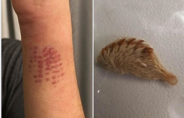 少年被可愛「貓毛蟲」叮咬　瞬間毒發手臂麻痺劇痛。（圖／翻攝自臉書）