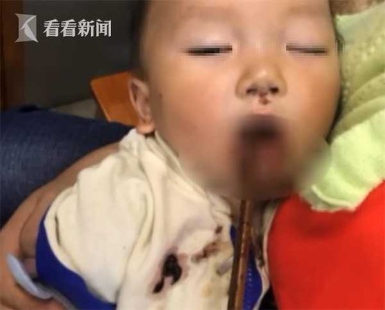 ▲▼貴州1歲半男童筷子插口腔、穿鼻腔插入眼眶。（圖／《看看新聞》）