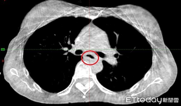 菸酒20年！10公分腫瘤塞滿她食道。（圖／澄清醫院提供）