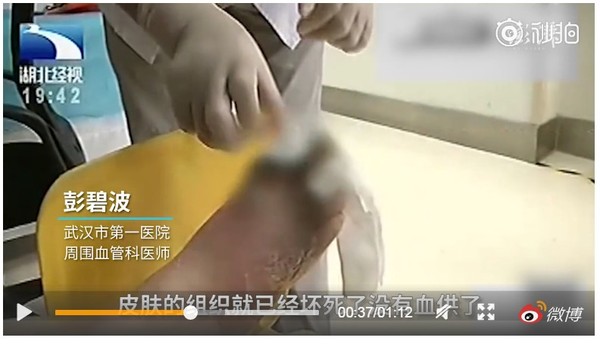 香港腳泡漂白水消毒　孝女害老母腳趾發黑壞死。（圖／翻攝自大陸揚子晚報的微博）