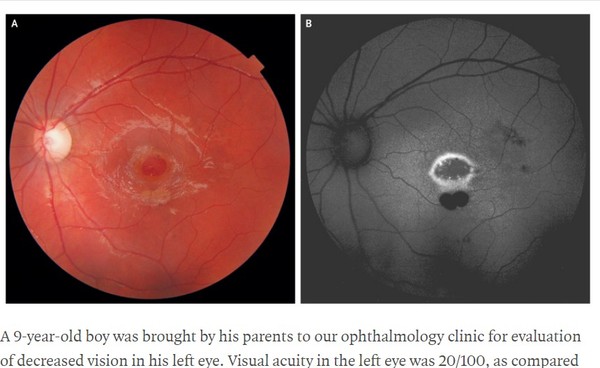 9歲童用雷射筆照眼　「視網膜被燒穿一個洞」。（圖／翻攝自（圖／翻攝自The New England Journal of Medicine網站）
