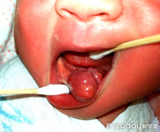 嬰兒有兩根舌頭？竟是先天性腫瘤！（圖／義大醫院提供）