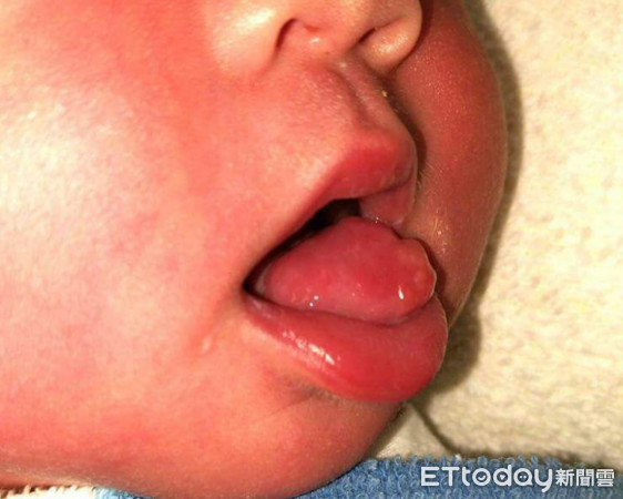 嬰兒有兩根舌頭？竟是先天性腫瘤！（圖／義大醫院提供）