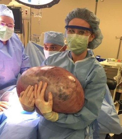 ▲▼減肥好幾個月都失敗，美國阿拉巴馬州30歲女子拉赫（Kayla Rahn）腹痛送急診，發現卵巢長23KG囊腫。（圖／翻攝自臉書Kayla S. Rahn；推特NetworkOfNews Ghana）