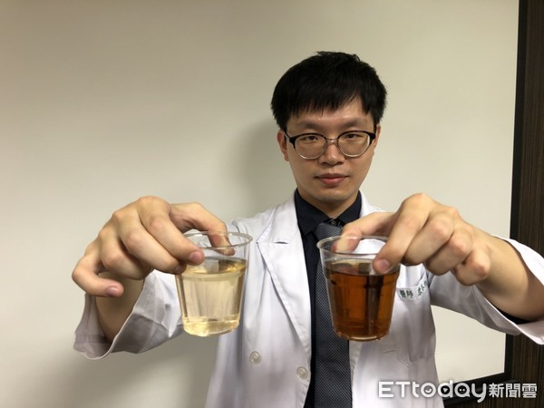 ▲尿液成紅茶色。（圖／書田診所提供）