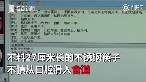 ▲▼江蘇女胃不舒服催吐，27公分筷子滑入食道。（圖／翻攝《看看新聞》視頻）