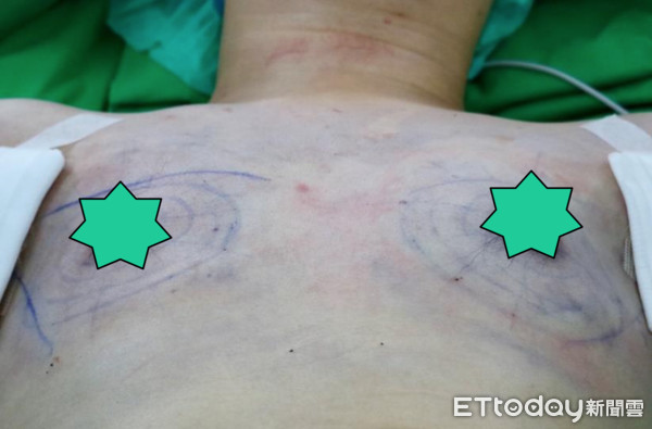 ▲C罩杯爬樓梯晃不停　同事笑他「大奶哥」還要集資買胸罩。（圖／三軍總醫院提供）