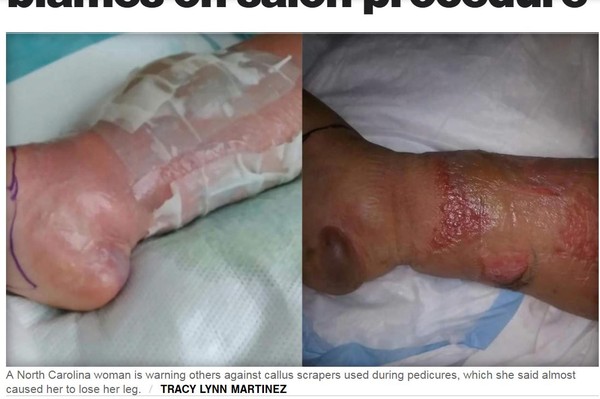 ▲▼女子磨腳皮釀成蜂窩性組織炎。（圖／翻攝自CBS NEWS）