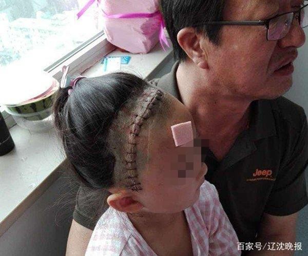 ▲▼瀋陽5歲女童被鉛彈射頭留15針蜈蚣疤　凶嫌抓到了！（圖／翻攝自遼瀋晚報）
