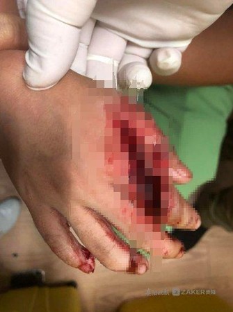 ▲女童的右手被館內鯊魚咬傷，當場鮮血直流，送醫後醫師發現有9處咬痕。（圖／翻攝自貴陽晚報）