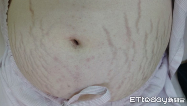 ▲臺北榮總引進最新庫欣氏症候群檢測方法。（圖／台北榮總提供）