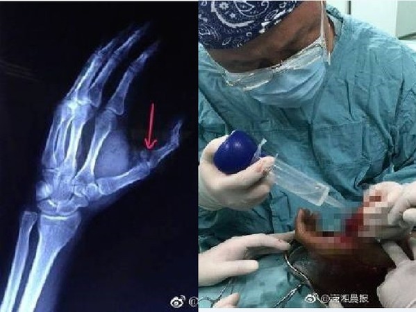 冷凍可樂變危險「炸彈」　男大生手指被炸到骨折。（圖／翻攝自大陸《瀟湘晨報》的微博）