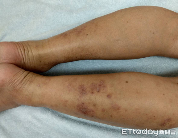 ▲一夜尿10次以為攝護腺腫大　翁就醫竟揪出「靜脈曲張」。（圖／書田診所提供）