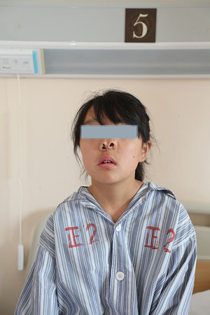 ▲▼三鼻孔女孩16年来學魚一樣呼吸　矯形手術還她鼻孔。（圖／翻攝自澎湃新聞）