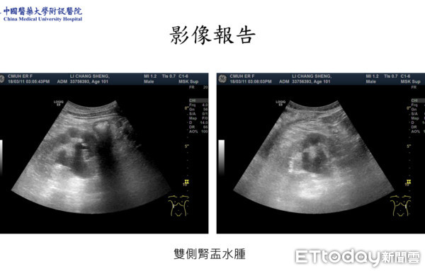 ▲百歲「勇健翁」腎功能剩2%　這手術讓他「走」回家過父親節。（圖／記者嚴云岑攝）