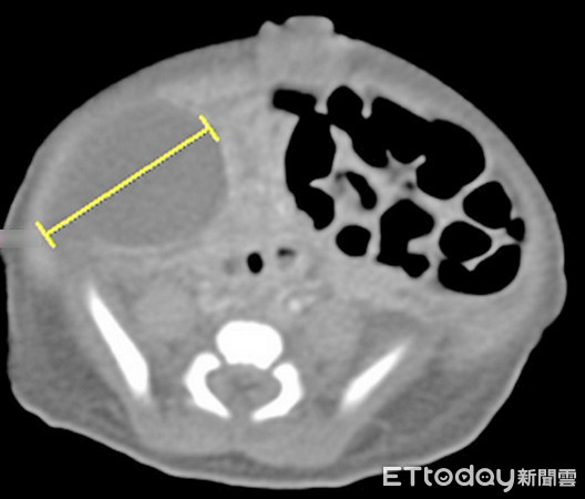 女嬰罹先天卵巢囊腫，4公分大囊腫占肚子近一半。（圖／記者趙于婷攝）