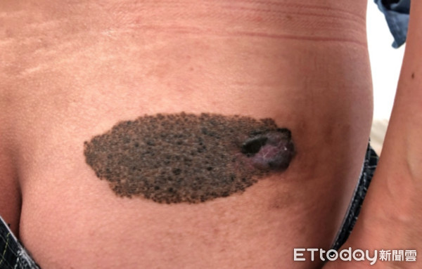 ▲屁股黑痣越長越大 他一抓「滿手墨水」...竟是四期癌。（圖／北榮提供）