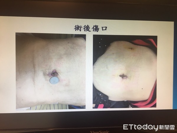 ▲吐血10年才知胃癌二期　醫幫他「摘全胃」卻沒留下任何疤。（圖／記者嚴云岑攝）