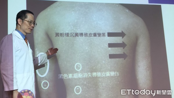 ▲手腳「黑白斑」被笑沒洗澡　長大才知罕病...全台僅9人有。（圖／記者嚴云岑攝）