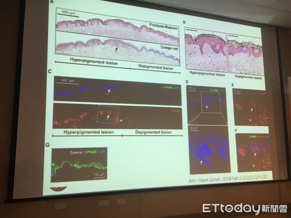 ▲手腳「黑白斑」被笑沒洗澡　長大才知罕病...全台僅9人有。（圖／記者嚴云岑攝）