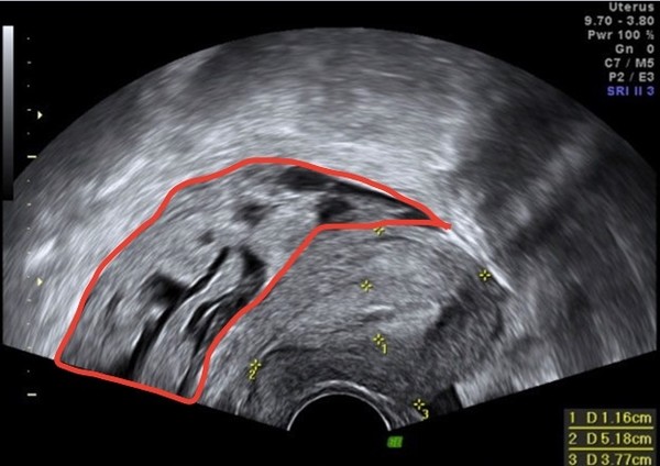 ▲▼超音波影像顯示子宮大小正常，子宮直腸窩(cul-de-sac)有不規則形狀塊狀腫瘤。（圖／國泰醫院提供）